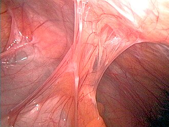 Adhesions after an appendectomy